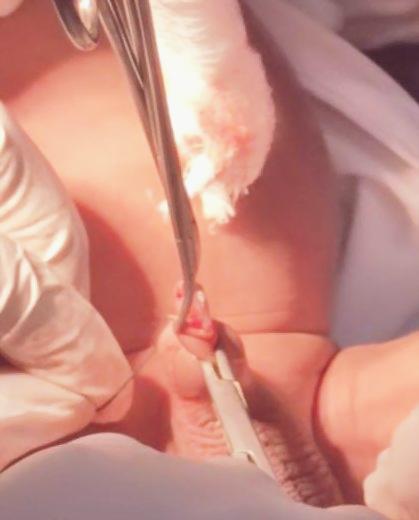 proses khatan bayi dengan teknik plastibell