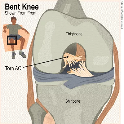 ACl koyak klinik tuah