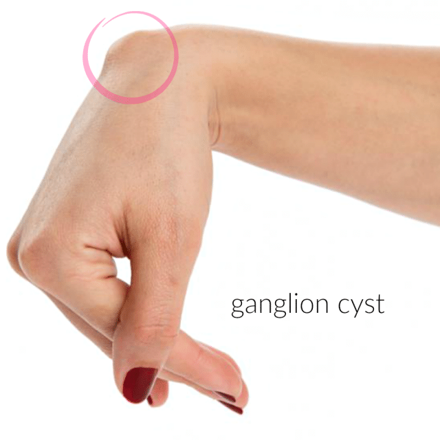 ganglion cyst di tangan
