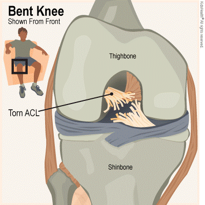 ACL koyak