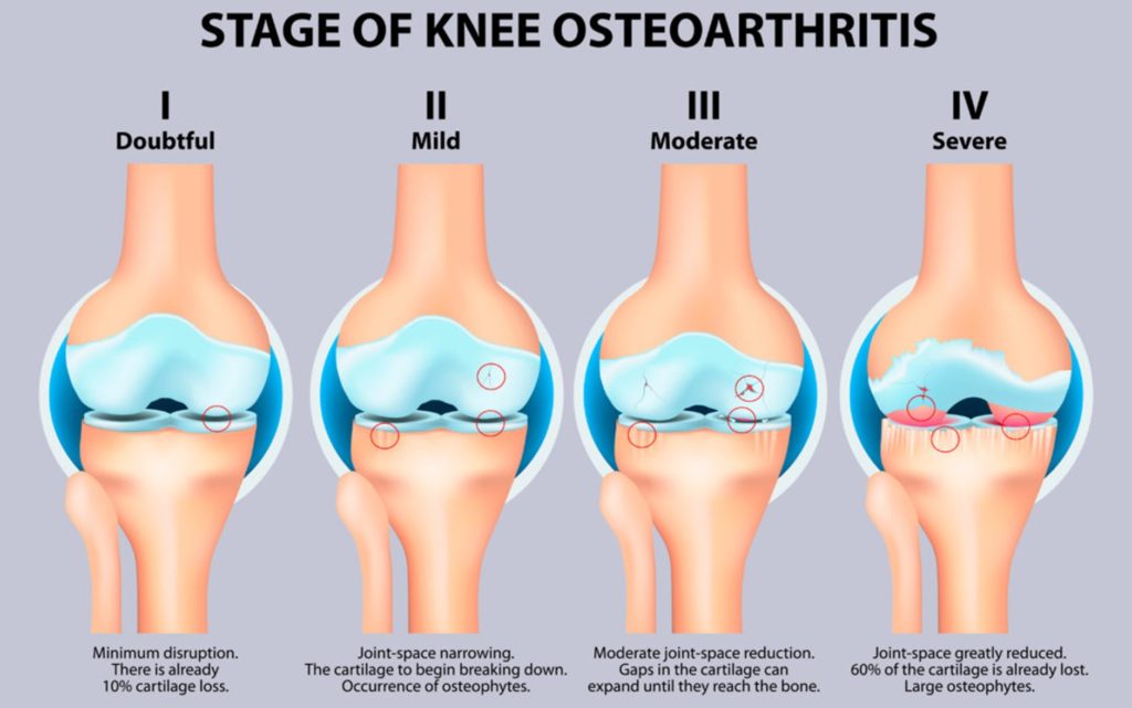 lutut osteoarthritis