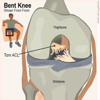 sakit lutut ACL