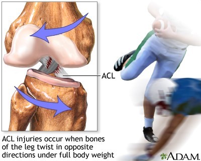 Imej ACL cedera kerana twisting 