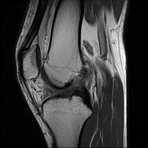 Imbasan MRI yang koyak 