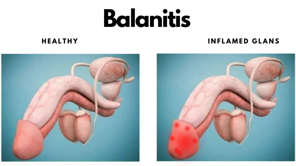 Image of balanitis that can come from poor genital hygiene - Circumcised vs Uncircumcised Klinik Tuah 