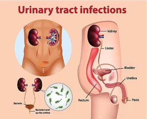 Circumcision meaning as to reduce risk of UTI 