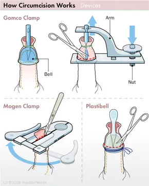 Clamp Circumcision Klinik Tuah 