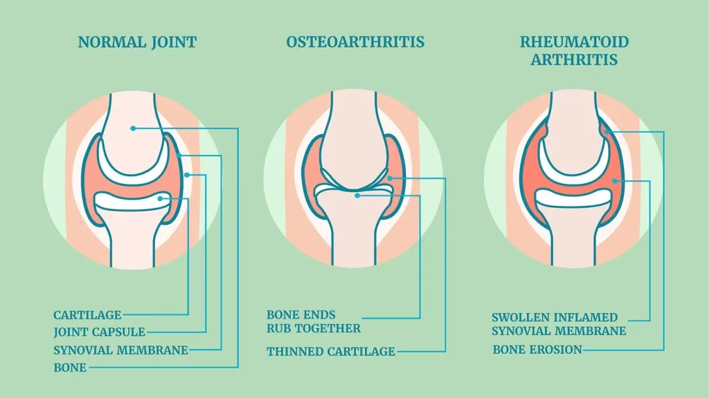 Comparison of normal joint, osteoarthritis and Rheumatoid arthritis 