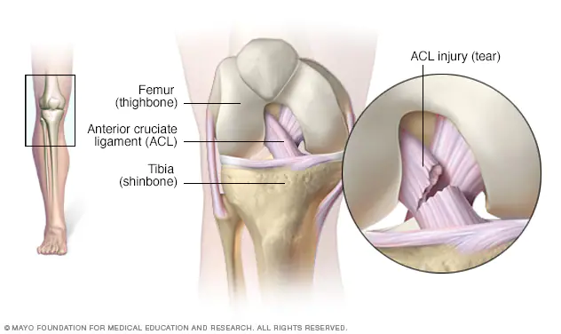 Image shows ACL injury that causes knee pain under article knee pain treatment klinik Tuah 