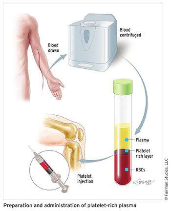 Image shows PRP injection procedure as knee treatment Klinik Tuah 