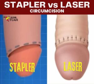 stapler vs laser