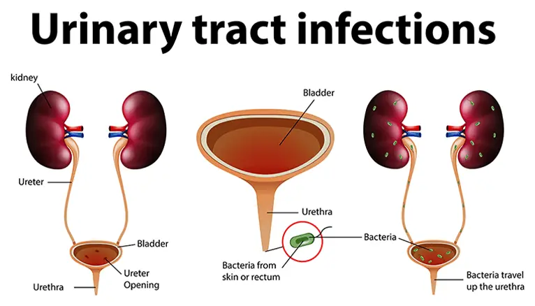 Image shows UTI which is the risk of uncircumcision.