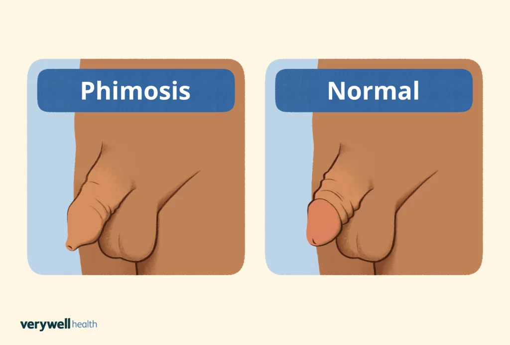 Image shows phimosis and normal penis  