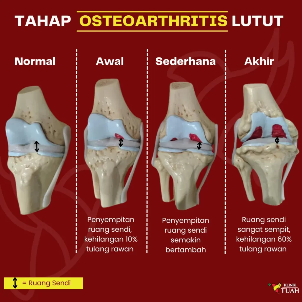 petanda sakit lutut klinik tuah 