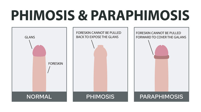 phimosis vs paraphimosis