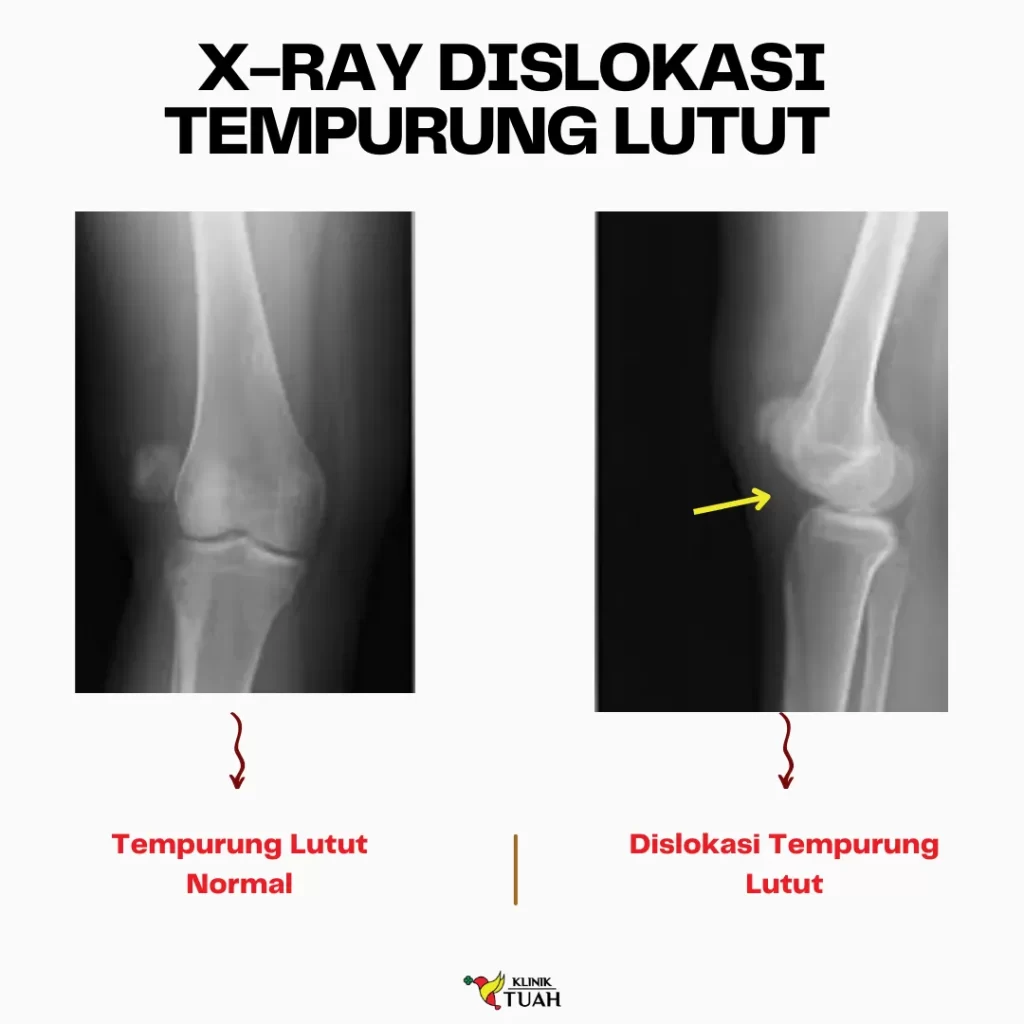 sakit lutut tiba-tiba akibat dislokasi tempurung lutut klinik tuah