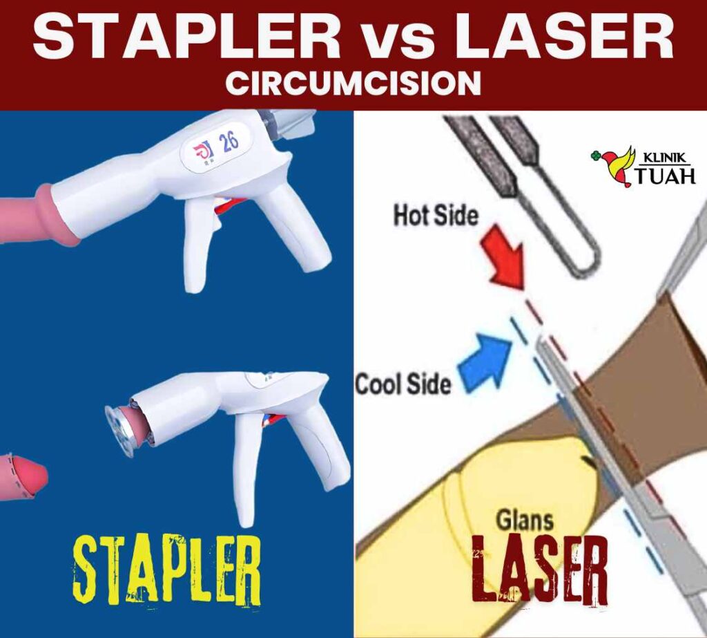 stapler vs laser procedure