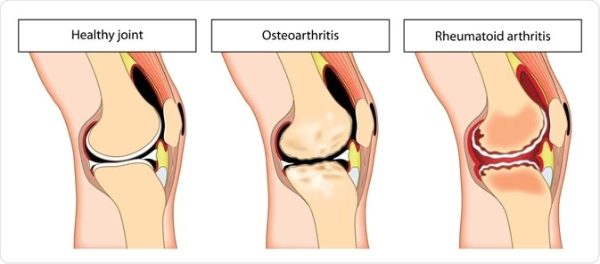 Image shows differences between healthy joint, osteoarthritis and rheumatoid arthritis