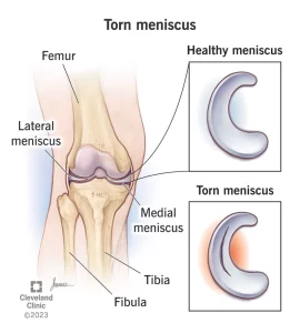 Image shows meniscus tears which is one of the main knee pain causes -Klinik Tuah