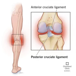 Image shows PCL tear which is one of knee pain causes 