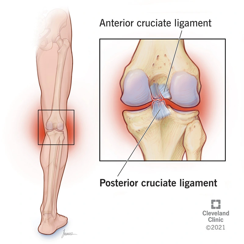 Image shows PCL tear which is one of knee pain causes