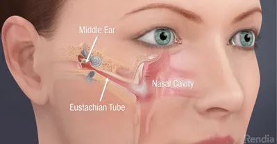  Eustachian Tiub Tersumbat Sebab Selsema -Klinik Tuah