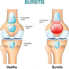 bursitis lutut yang menyebabkan sakit lutut kiri 