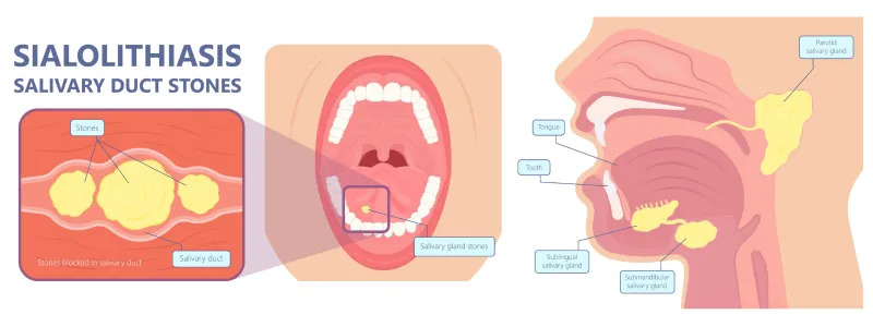 Sialolithiasis punca benjolan di leher klinik tuah