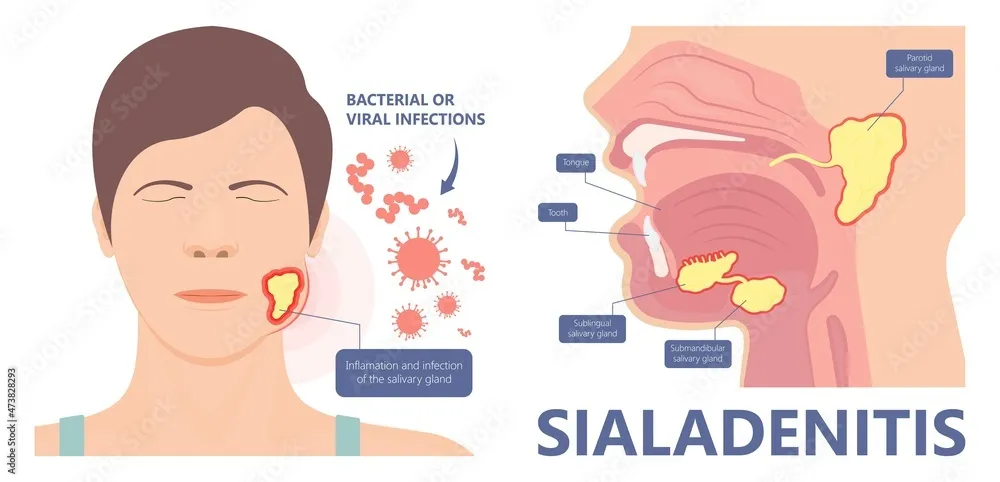 Sialadenitis punca benjolan di leher klinik tuah