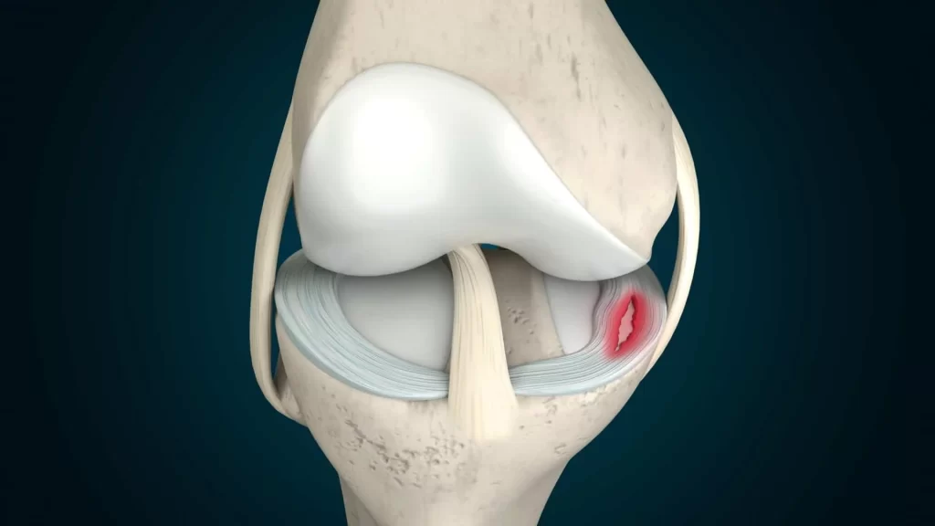 meniscus tear di bawah artikel klinik sakit lutut di kuantan 