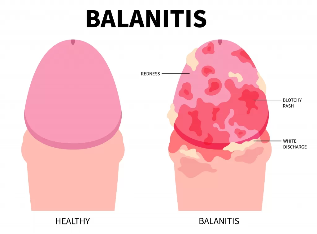 zakar buta akibat balanitis klinik tuah