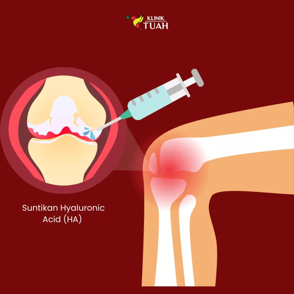 suntikan gel lutut klinik tuah