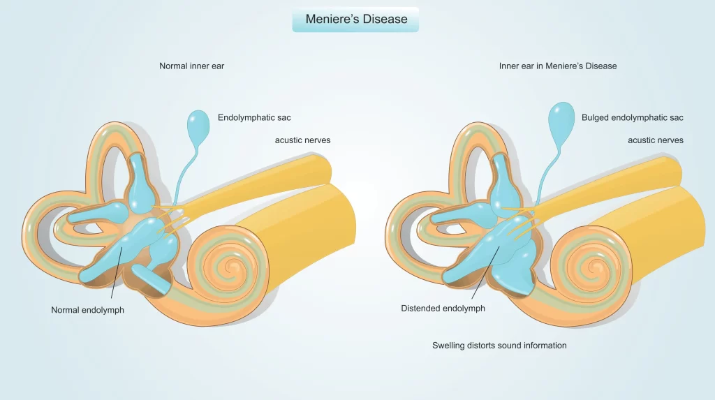 telinga berdesing akibat meniere's disease klinik tuah