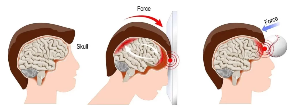 TBI menyebabkan telinga berdesing klinik tuah