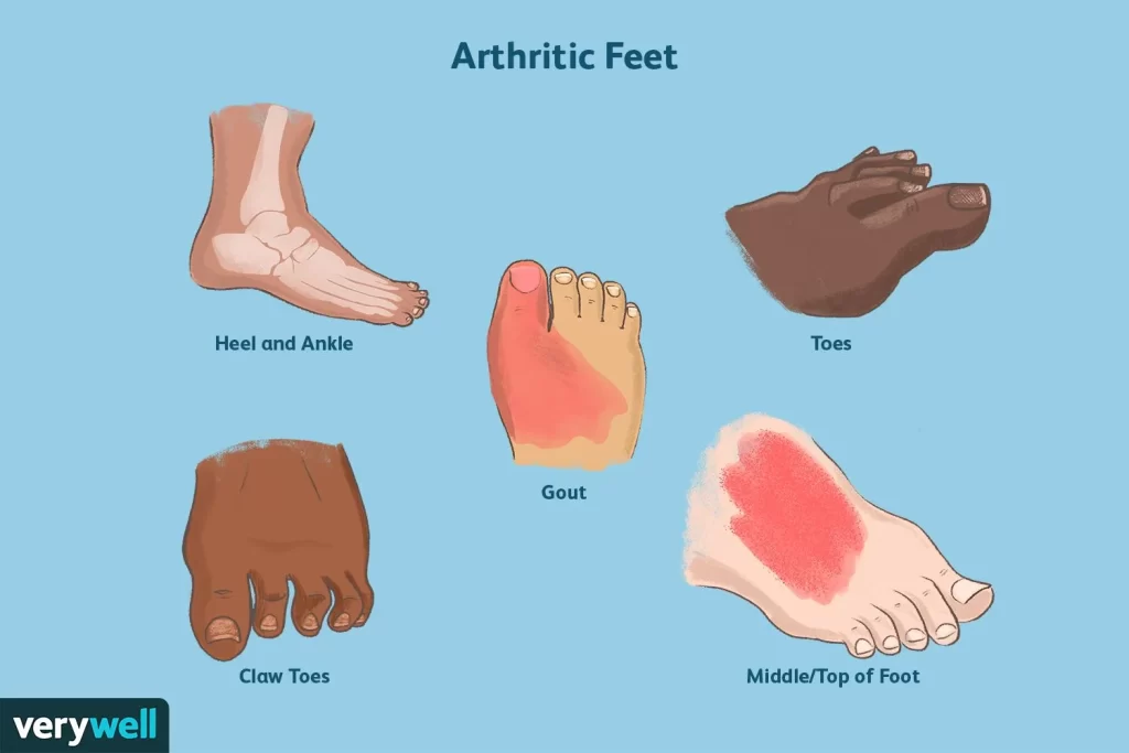 jenis arthritis yang menjadi punca sakit tapak kaki bagi wanita