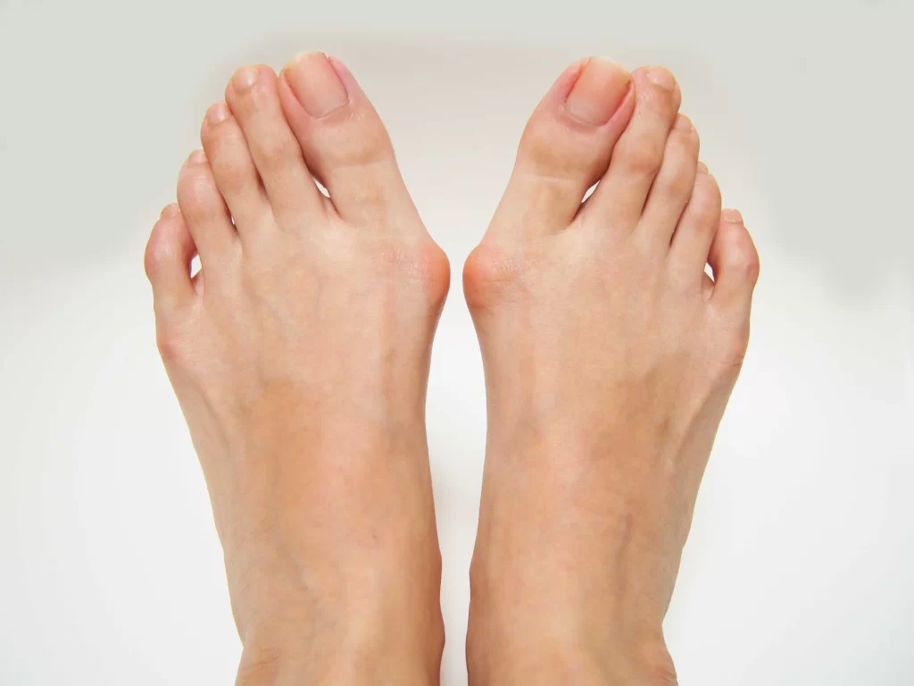 bunion punca sakit tapak kaki bagi wanita