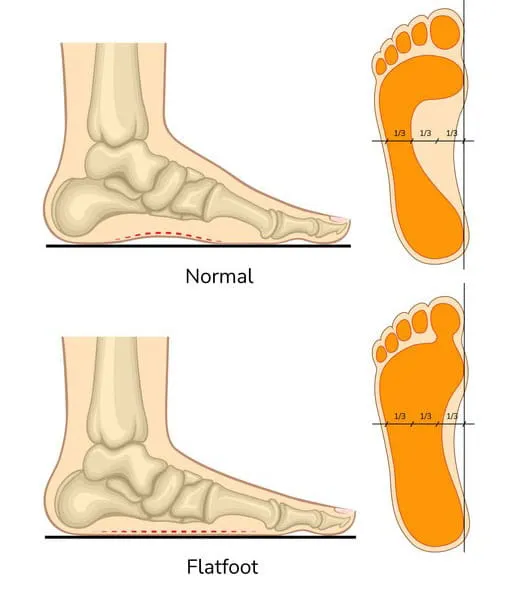 tapak kaki rata punca sakit tapak kaki bagi wanita