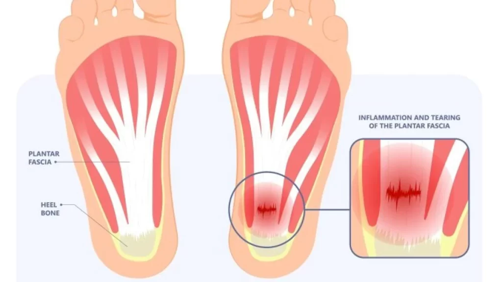 gambaran plantar fasciitis yang menjadi punca sakit tapak kaki bagi wanita