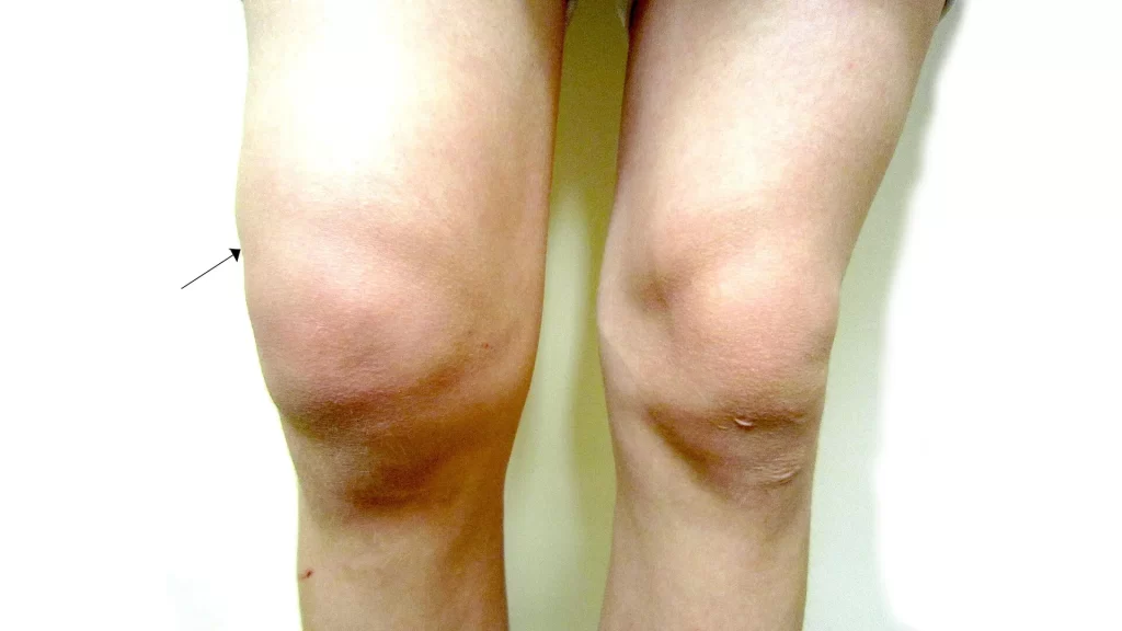 knee effusion