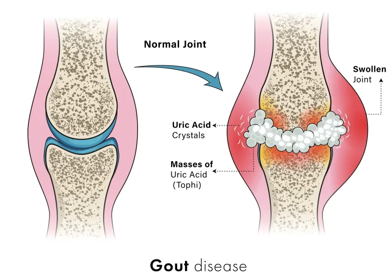 gout causes knee effusion