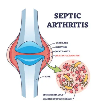 septic arthritis causes knee effusion