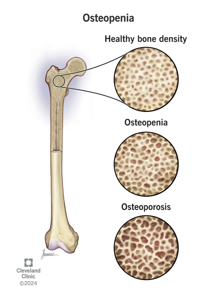osteopenia di bawah artikel vitamin untuk lutut