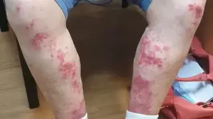 Pesakit yang alergik dengan NSAIDs sesuai mengambil glucosamine untuk lutut