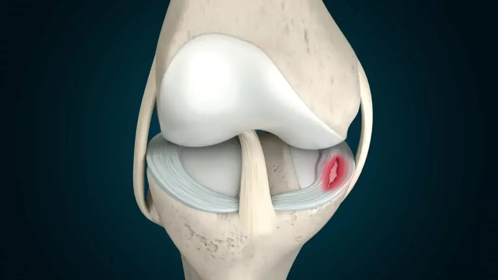 meniscus tear di bawah artikel klinik sakit lutut di kuantan