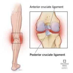 Image shows PCL tear which is one of knee pain causes