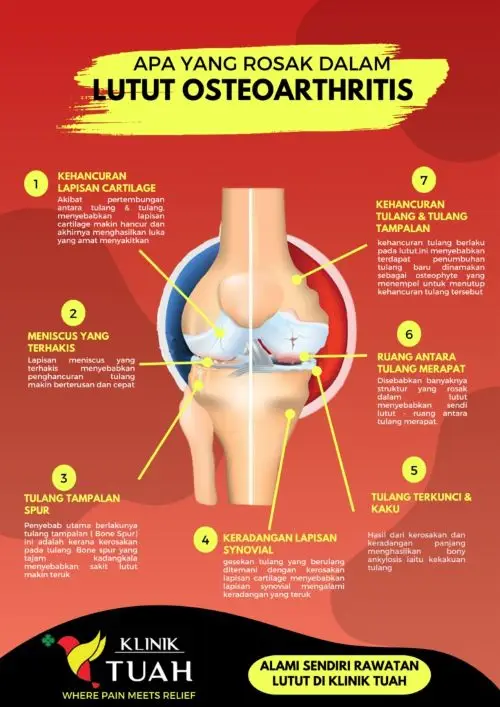 kerosakan dalam lutut osteoarthritis