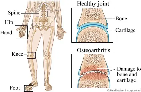anggota badan yang boleh mendapat arthritis selain lutut osteoarthritis