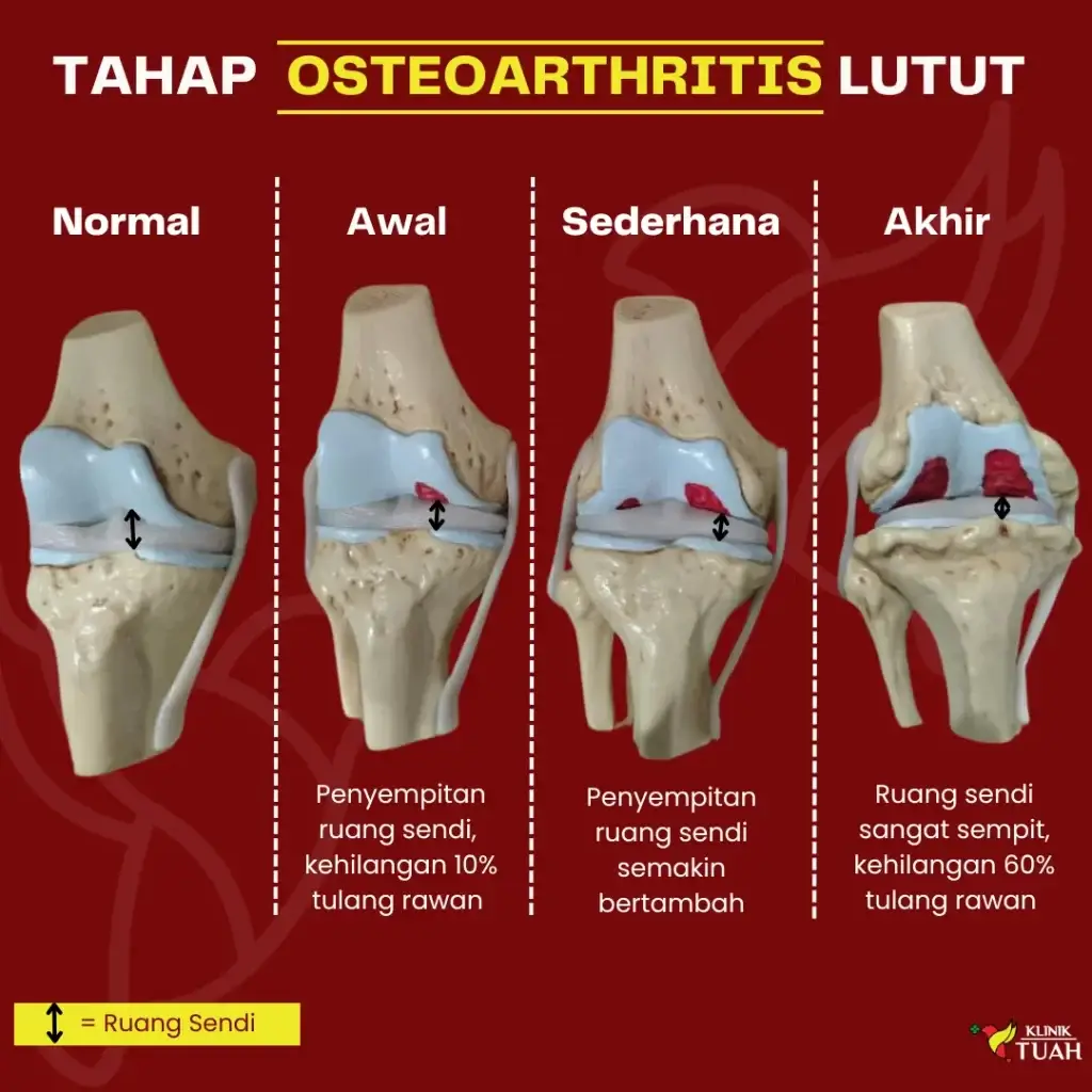 tahap lutut osteoarthritis