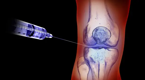 suntikan viscosuplemen untuk merawat lutut osteoarthritis