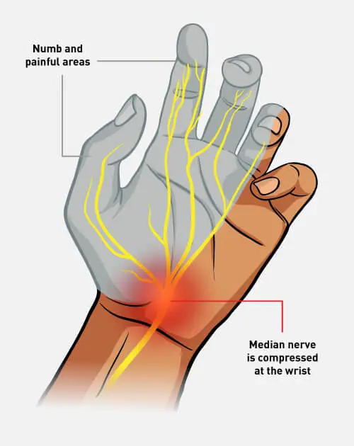 Carpal tunnel punca sakit jari tangan